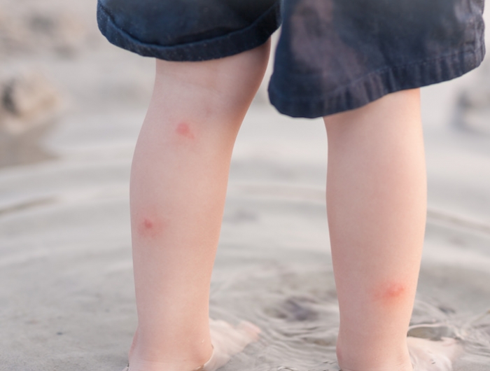 red itchy bites on toddler boy's legs