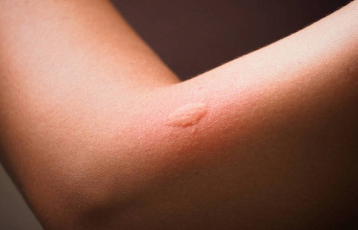 piqûre moustique gonflement comment le soigner