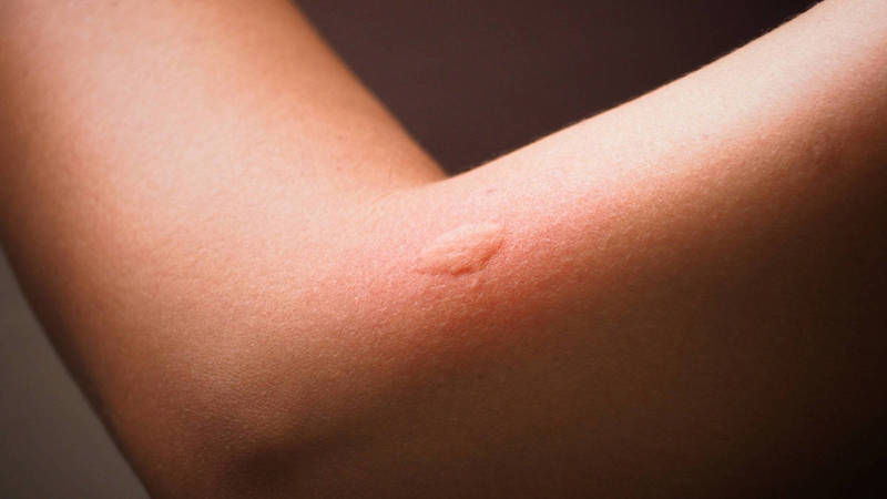 piqûre moustique gonflement comment le soigner