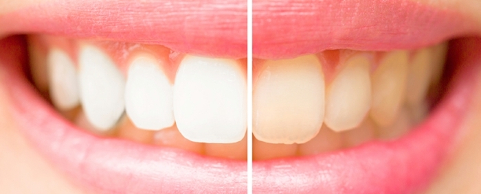 les inconvenients du citron sur l organisme dents blancs et dents détériorés