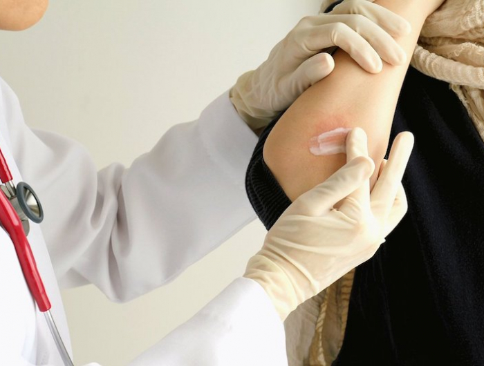 a quoi sert le curcuma en medecine main de femme souffrant d eczema