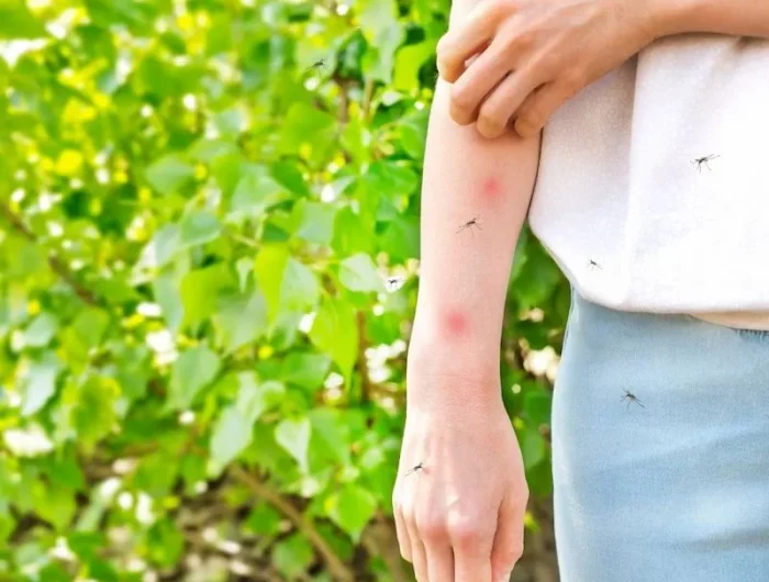 allergie piqure moustique et comment reconnaître une piqûre traitement démangeaison