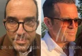 Comment choisir la bonne clinique de greffe de cheveux DHI ?