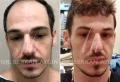 Comment choisir la bonne clinique de greffe de cheveux DHI ?