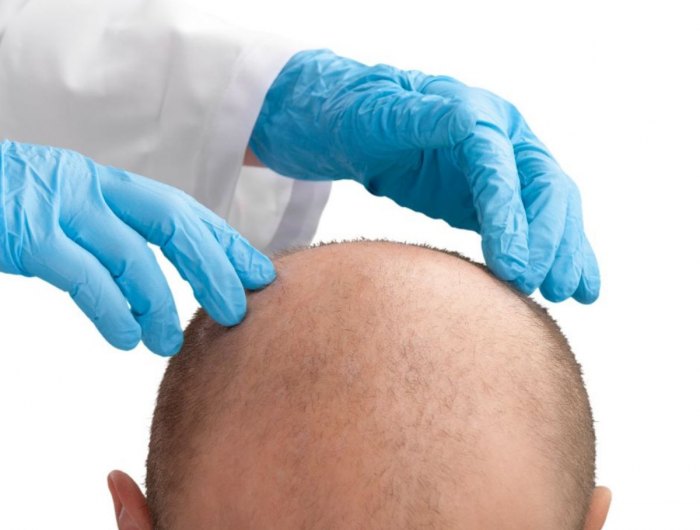 soigner alopecies avec du greffe de cheveux en turquie