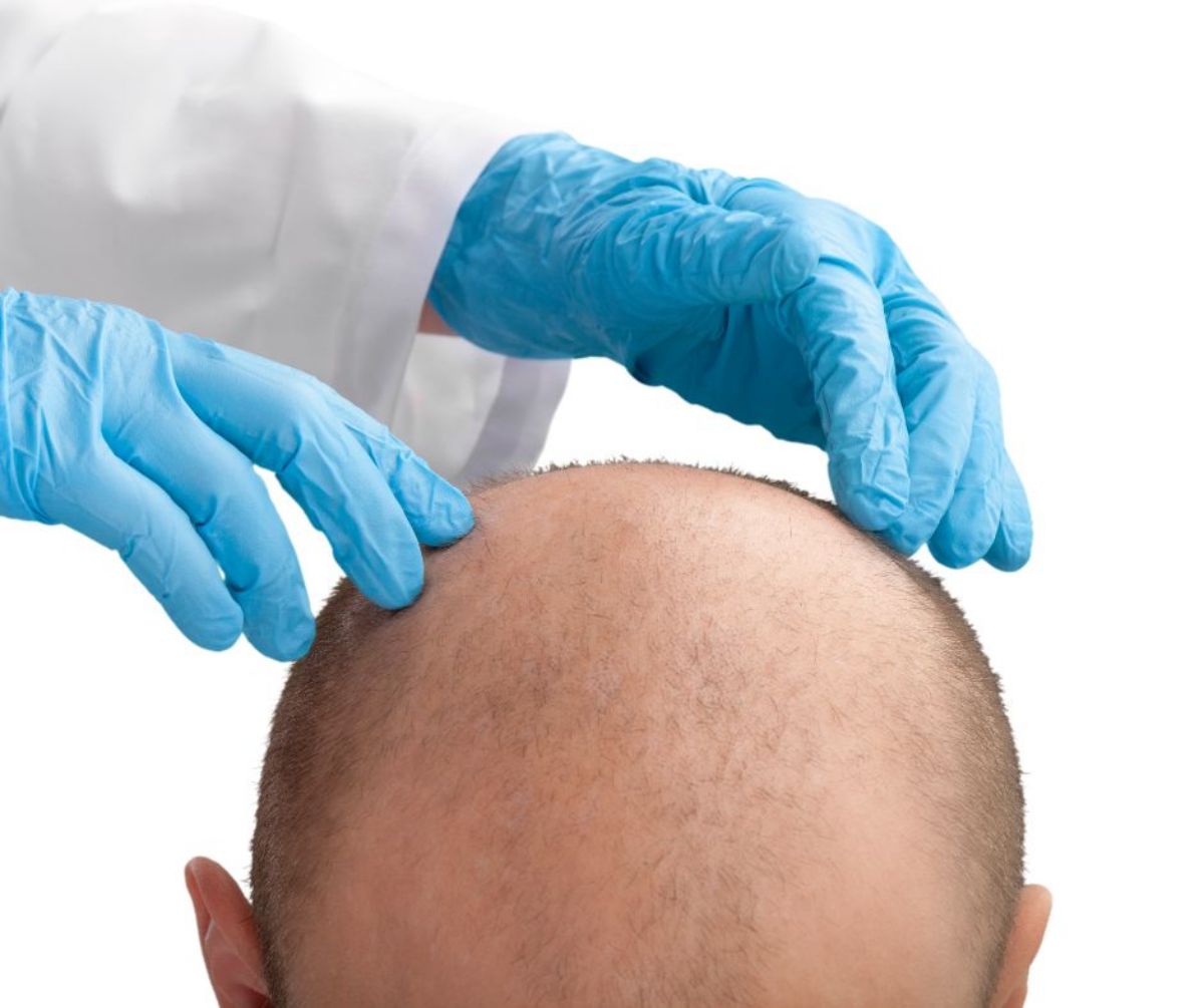soigner alopecies avec du greffe de cheveux en turquie