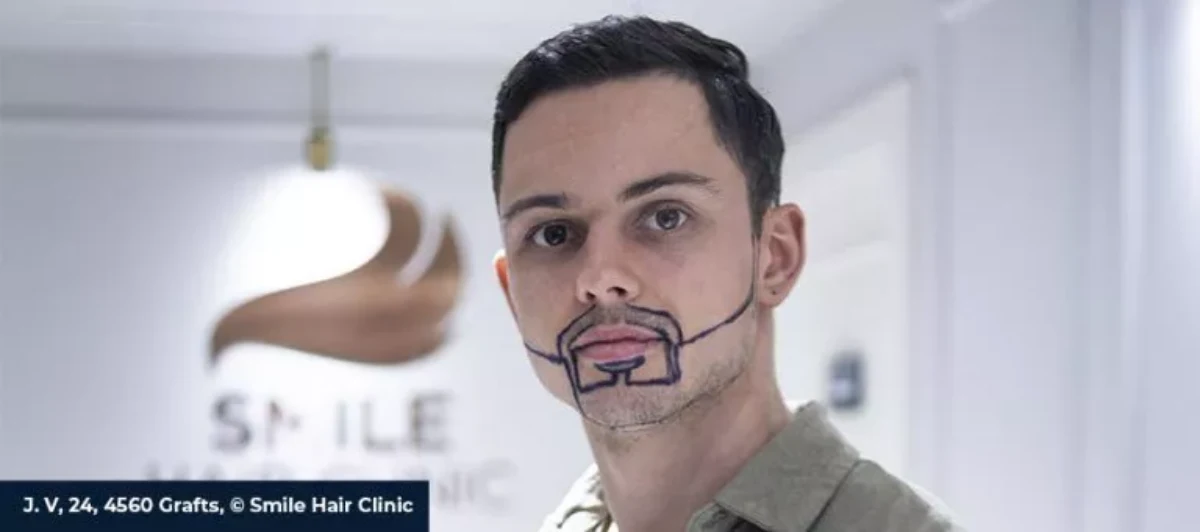 greffe de barbe istanbul meilleure clinique