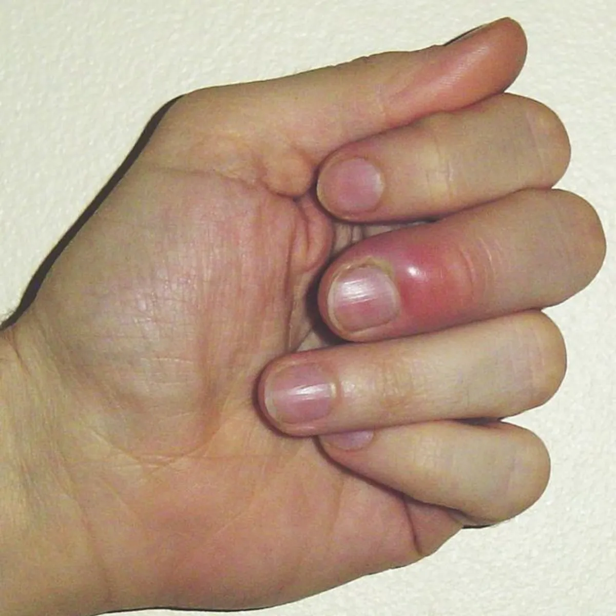 faire regulierement ses ongles avec du gel comporte des risques paronychie