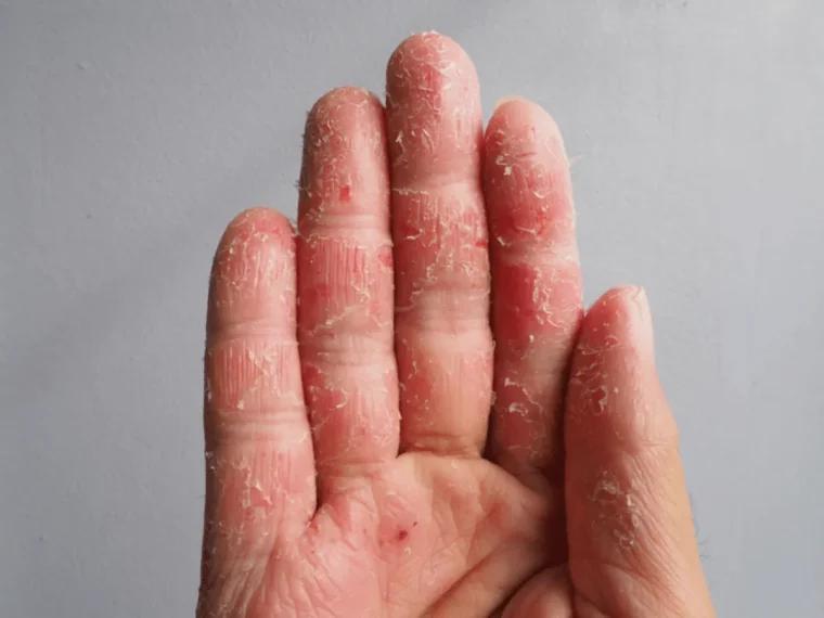 faire regulierement ses ongles avec du gel comporte des risques peau abimee