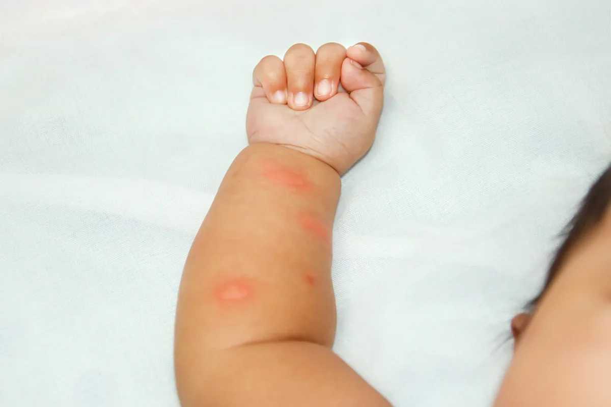 comment traiter les piqueres d insectes sur la peau des bebes