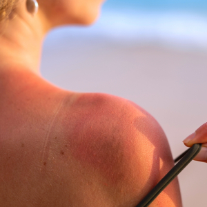 comment faire derougir un coup de soleil rapidement femme au soeil