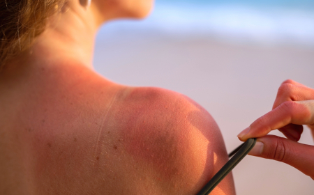 comment faire derougir un coup de soleil rapidement femme au soeil