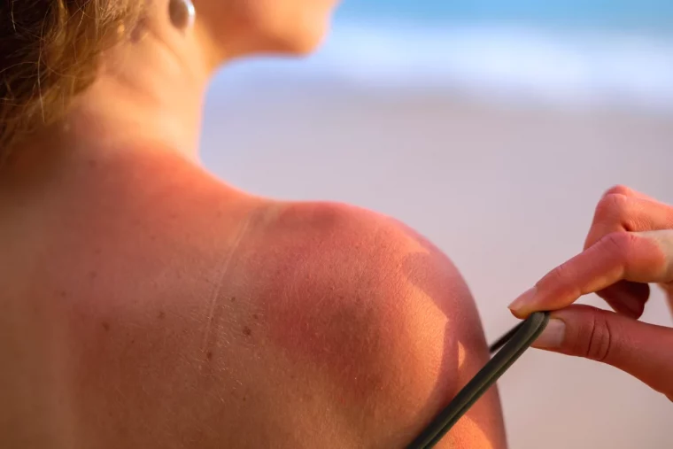 comment faire derougir un coup de soleil rapidement femme au soeil